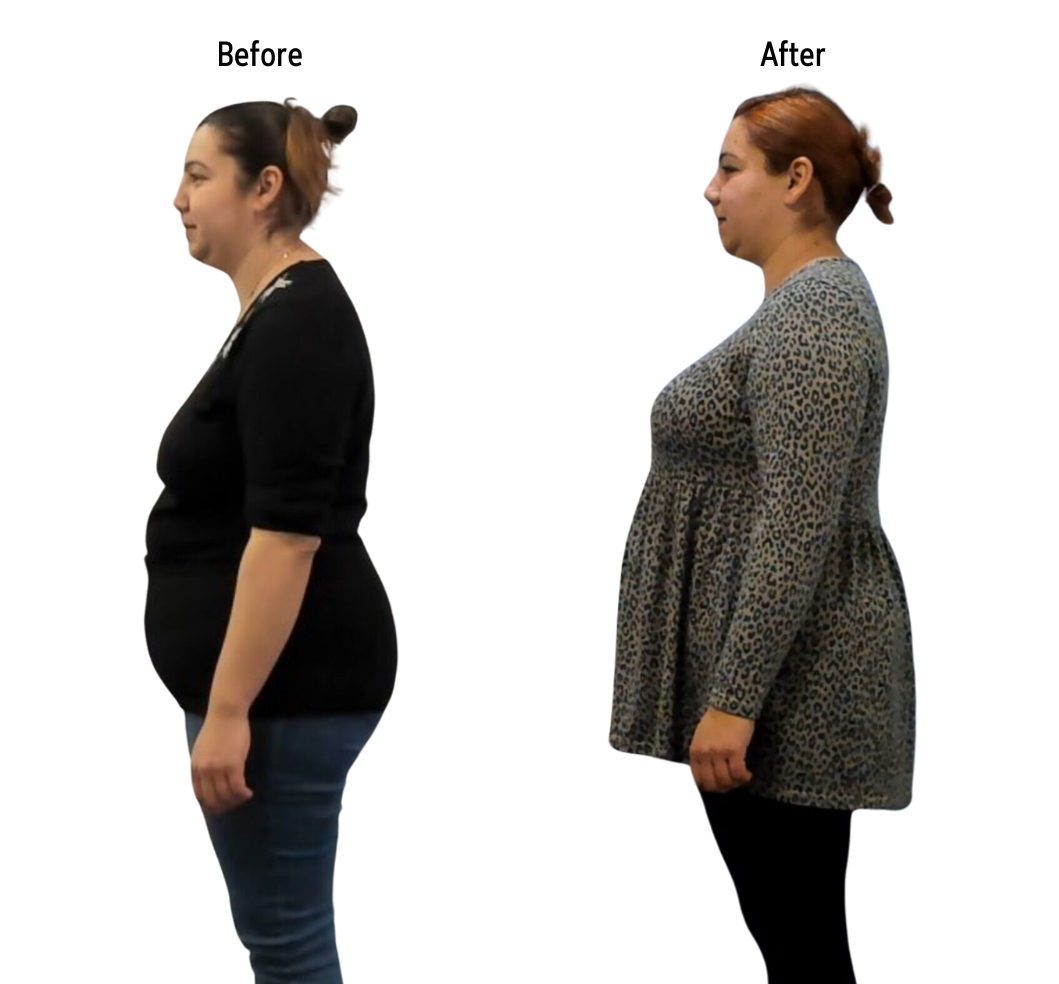 Two full body, side view pictures of a woman, showing her shoulders and posture straightening after Advanced BioStructural Correction™ treatments.