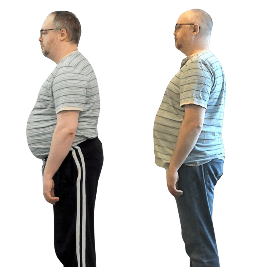 Before vs 2 years of care with Advanced BioStructural Correction™