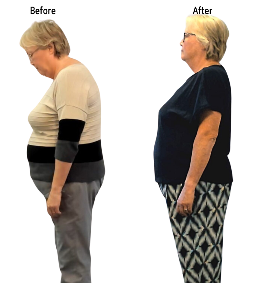 Two full body, side view pictures of a woman, showing her shoulders and posture straightening after Advanced BioStructural Correction™ treatments.