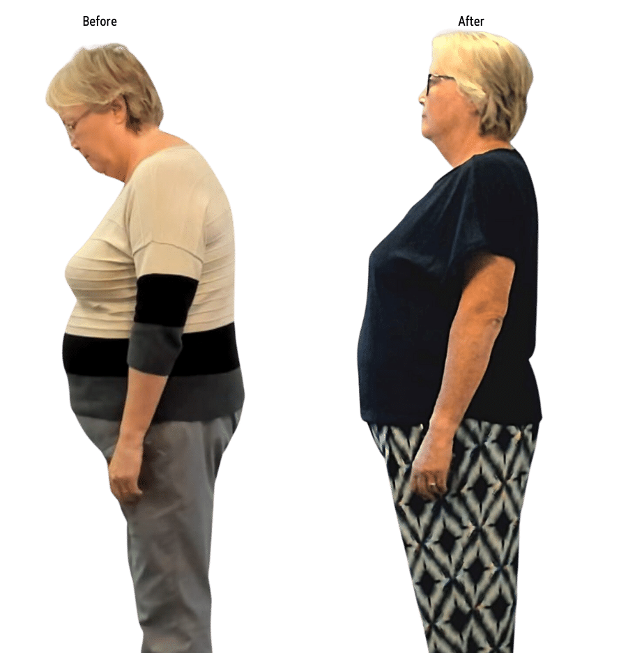 Two full body, side view pictures of a woman, showing her shoulders and posture straightening after Advanced BioStructural Correction™ treatments.