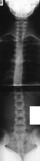 scoliosis02