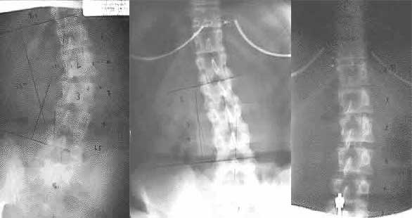 scoliosisComposite