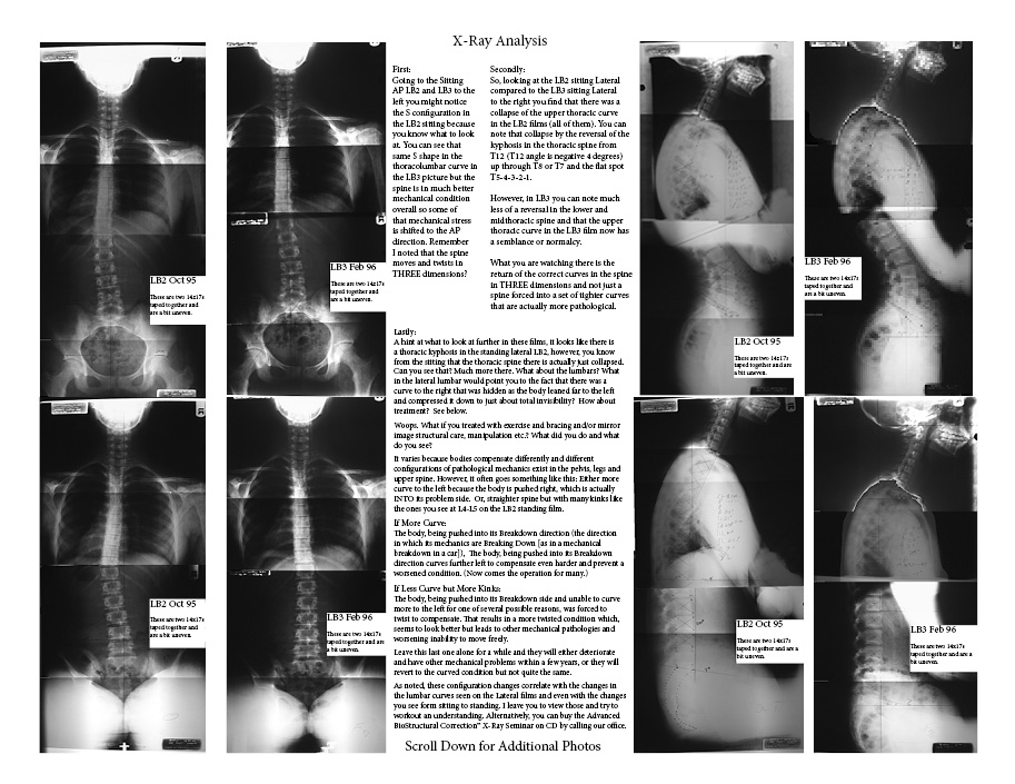 xrayanalysisidiopathicscoliosis