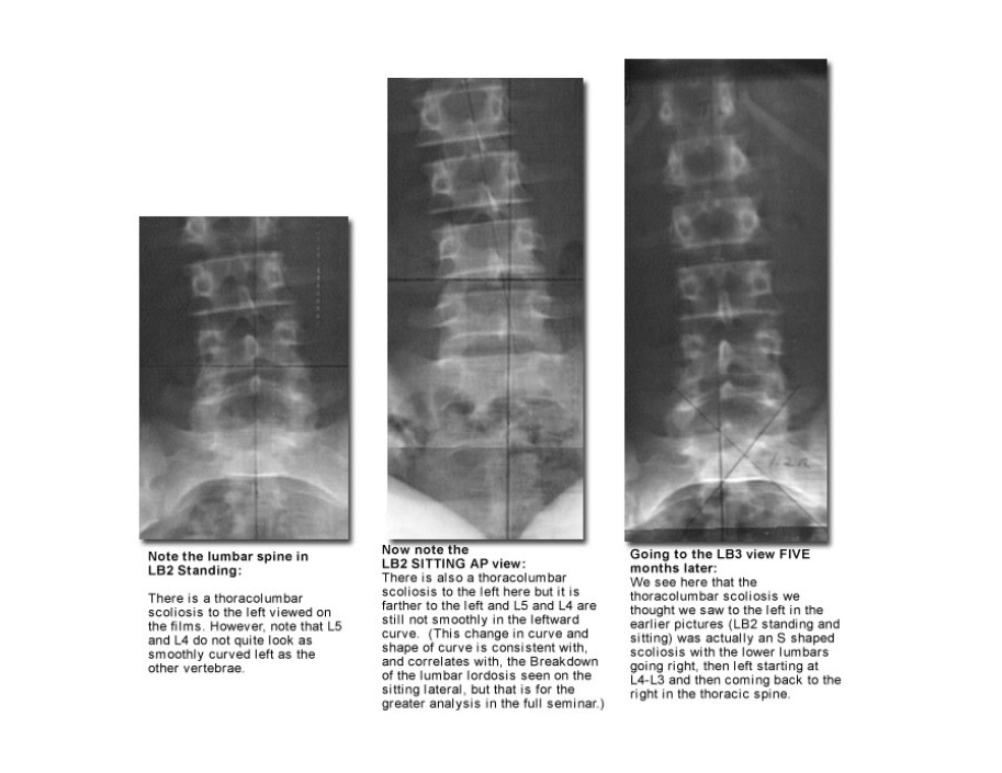 xrayanalysisidiopathicscoliosis2